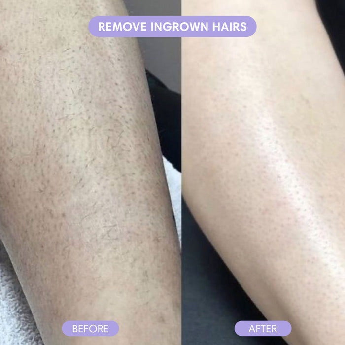 Crystal Hair Removal - Painless Hair Eraser